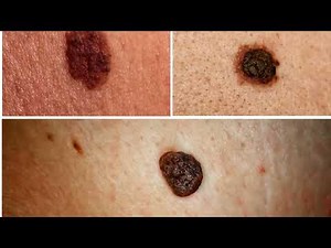 Spotting Cancer Early: Essential Guide