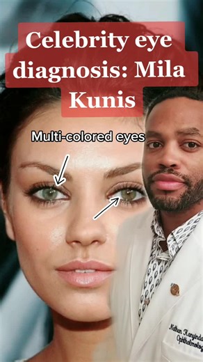 Celebrity Eye Colors: Exploring Mila Kunis' Heterochromia