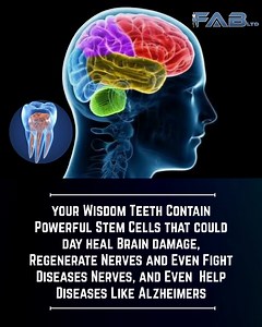What’s scientifically accurate Wisdom teeth contain stem cells. Specifically, dental pulp stem cells DPSCs are found inside wisdom teeth and other teeth. These stem cells are multipotent. In lab and animal studies, DPSCs can differentiate into: Bone cells Cartilage Fat cells Neuron-like cells Schwann like cells support nerve repair They show promise for nerve repair. DPSCs release neurotrophic factors that support nerve survival and regeneration in experimental models. Collection is relatively e