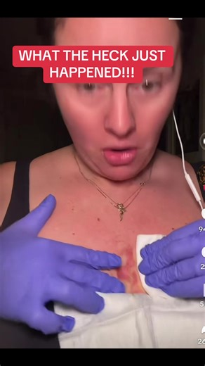 It hit my face, and the phone #fyppppppppppppppppppppppp #xyzbca #viral #funny #cyst
