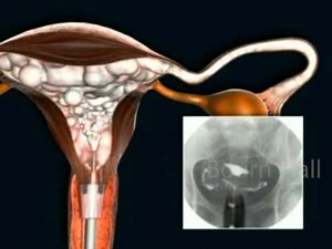 Hysterosalpingogram - Bournhall Clinic