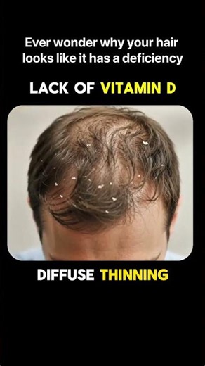 Hair Loss Signs & Nutrient Deficiencies You Shouldn't Ignore! 💇‍♂️
