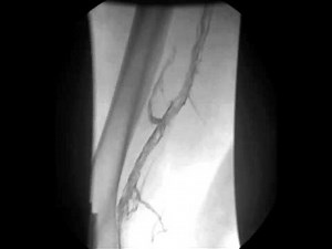 Leg Venographic Images Obtained before and after Thrombolysis