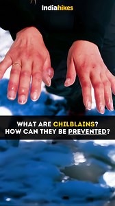 If you’re hearing this word for the first time and thinking: “What is a Chilblain? How does it matter to me as a trekker?” Then, you need to watch this video. Chilblains are one of the most common yet overlooked cold-related issues trekkers face in winter. They appear as painful, itchy swellings on your toes, fingers, ears, or nose when exposed to cold and damp conditions for too long. If you’ve ever felt a burning sensation or noticed red patches on your skin after a trek, you might have experi