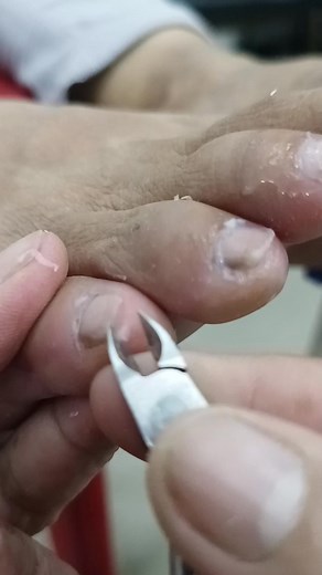 Mahirap magtanggal ng mga dryskin kapag mapurol ang nipper #fypシ゚viralシfypシ゚viralシalシ #fbreelsfypシ゚viralシ #reelsvideoシ #facebookreelsviral #FacebookPage #ContentMonetization #allaroundnanay | All Around Nanay