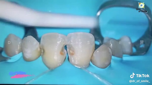 Upper Anterior Teeth Direct Layering Composite Restoration Guide