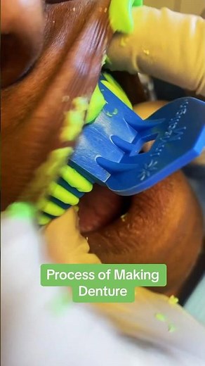 Toothless? Process of making denture #dentist