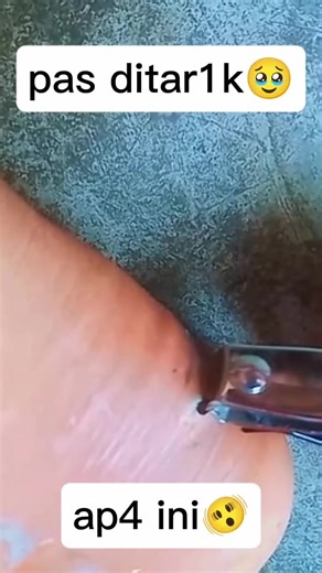 6.2K views · 35 reactions |  It looked small, but wait till you see the ending! #drpimplepopper #grossaddiction | Pimple Popping | Facebook