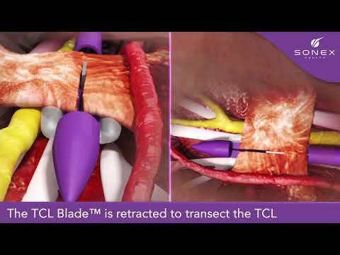 UltraGuideCTR Animation Carpal Tunnel Release with Real Time Ultrasound Guidance