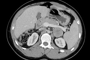 Tumours of the adrenal gland: the oncological and endocrine components