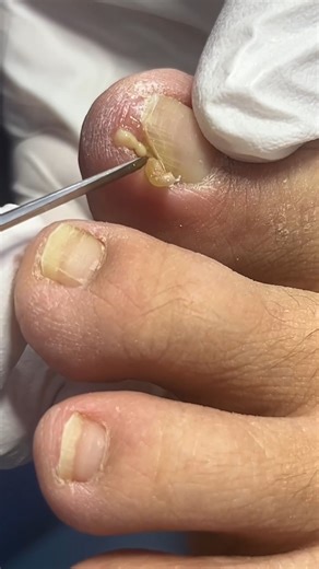 Nail Art | Removing swollen and infected ingrown toenail 🦶 #ingrownnail #footcare #trending #viral | Instagram