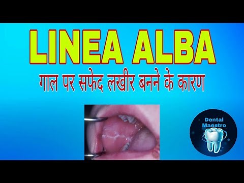 Linea Alba | white line on cheek | Dental Maestro | Dr.Jyoti Agarwal