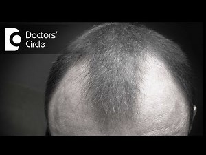 Can minoxidil be helpful in treating bald patches in young men? - Dr. Rasya Dixit