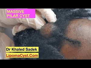 Massive Pilar Cyst. Dr Khaled Sadek LipomaCyst.com