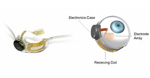 “Artificial retina” wins European approval
