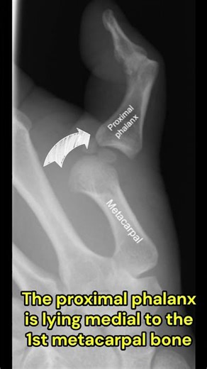 Left thumb metacarpophalangeal joint dislocation