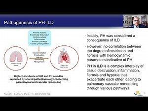 A Deeper Dive into the Early Recognition, Diagnosis, and Treatment of PH Associated with ILD