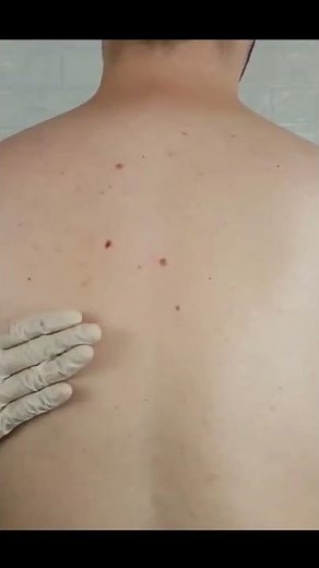 Back Allergy Testing - Check Up *ASMR* #Shorts