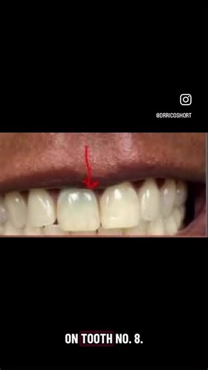 The SHORT Case Of The Day! Tooth 8 - Dark Tooth / Hx of Trauma / Endo Patient had sporadic discomfort and came for a second opinion on tooth 8. Her dentist said she didn't see anything wrong with the previous root canal. The tooth had a dark hue to it. A 2D image was taken. The previous root canal looks well done. A LFOV 3D CBCT was taken with my Carestream Dental 3D CBCT unit. It showed periapical pathology present. Endodontic retreatment was performed in one visit. There was necrotic pulp tiss