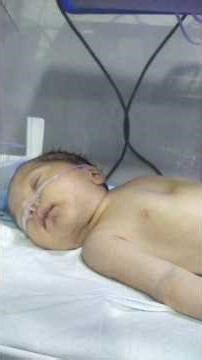 RDS Grade 3 Baby in NICU | Severe Breathing Distress & Intensive Care 👶🫁