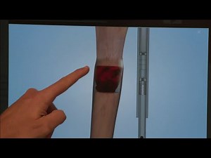 People with leg length discrepancy being given new approach for help