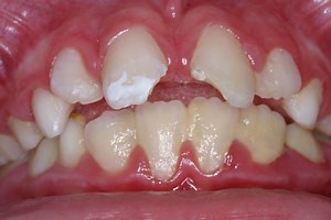 Dental trauma: What to know and what to do - MyJoyOnline