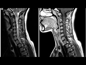The MRI Cervical Spine //Positioning//Procedure//Filming