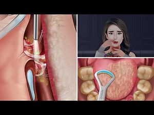 ASMR Removal for a girl who choked on a giant nut and treated swollen teeth.