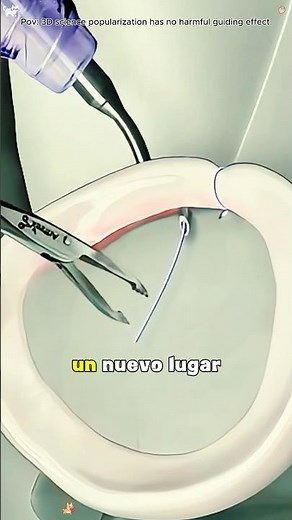 How Arthroscopic Bankart Repair Surgery Is Performed (3D Animation)#bankartrepair#3danimation