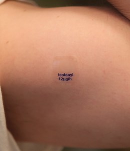 Wearable Patch Can Efficiently Deliver Drug To Treat Skin Cancer