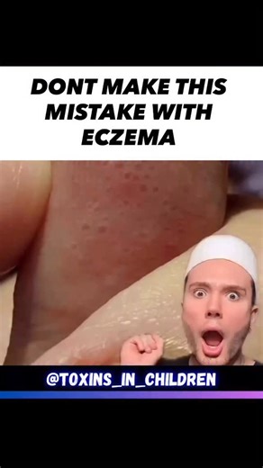 It starts with a tiny itch. A rash that looks harmless, Maybe a little blister between the fingers, a dry patch near the heel. You’re told it’s eczema, You’re given creams, You’re told to “avoid dairy” or “try gluten-free.” But no one talks about nickel. Nickel is the quiet chaos agent. It builds up when your liver’s overburdened, your minerals are depleted, and your detox pathways are blocked. And guess what your body does with the overload? It pushes it out through your skin. That’s why these 