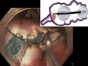 Purely endoscopic appendectomy