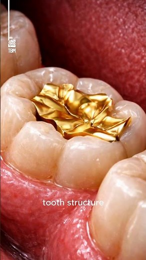 Gold Dental Restorations