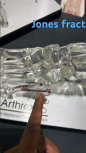 Jones fracture