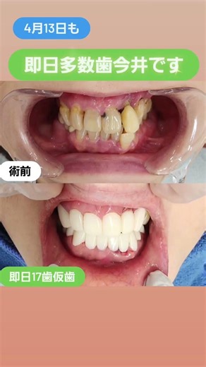 即日多数歯今井です。歯周病が進んでおり、グラグラしている前歯、歯並びでお悩みの方。カウンセリング当日17歯仮歯まで進めていきました。お悩みはその日即日がダイヤモンド今井院長流です #セラミック