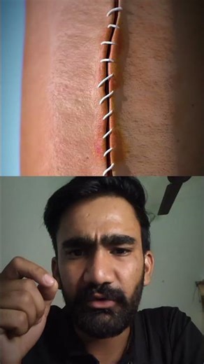 Stitches Healing Explained