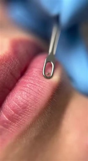 Effective Blackhead Removal Techniques for the Lip Area