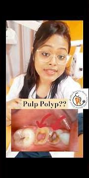 Pulp Polyp how to treat it🦷✅#youtubeviral #dentaltreatments #trending