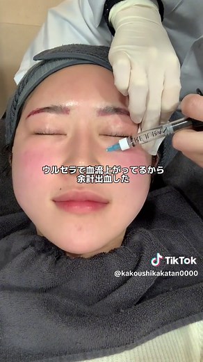 @ユジンス医院【韓国皮膚科】 シュリンク、ハイフ系の骨に響く感じがマヂで耐えられへん人は麻酔クリームやったら悶絶するかも。。ですね。 #ウルセラ #リジュラン #韓国美容課金 #韓国美容クリニック #韓国美容皮膚科 #韓国肌管理 #江南肌管理 #渡韓情報 #渡韓整形#渡韓ごっこ