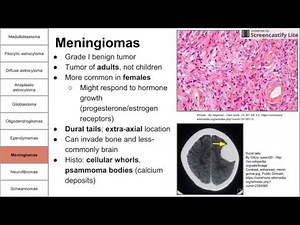 Nervous System Tumors