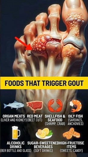 8 Common Foods That Can Trigger a Gout Flare-Up Overnight