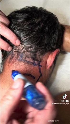 CERVICALGIA PERSISTENTE, CEFALEAS, ESTRÉS.