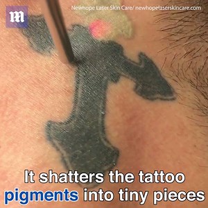 31K views · 87 reactions | This new laser makes embarrassing tattoos disappear! Credit: www.NewhopeLSC.com | Daily Mail Video | Facebook