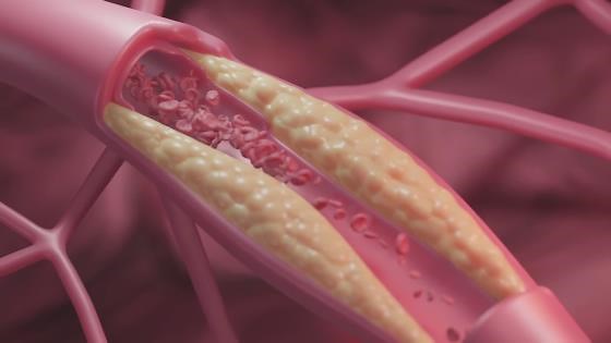 Understanding lipoprotein(a) and cardiovascular risk