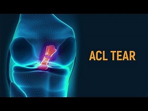 What Causes An ACL Tear?