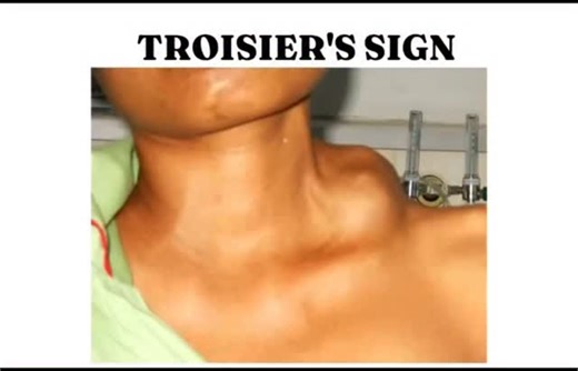 RK NURSE'S HUB on Instagram: "Troisier’s sign is a clinical finding characterized by a palpable, hard, and enlarged lymph node in the left supraclavicular fossa. This specific lymph node is known as Virchow's node. Clinical Significance The presence of Troisier’s sign is highly significant in medicine because it often serves as the first clinical indication of an advanced, occult malignancy, most commonly originating from the abdomen or pelvis. Primary Cause: Historically and most frequently ass