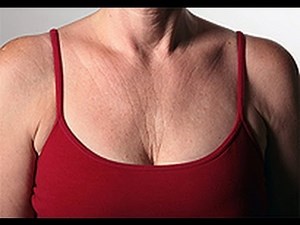 How to Treat Cleavage Wrinkles [DermTV.com Epi #491]