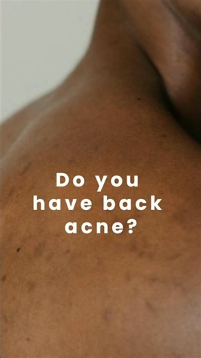 Top 5 treatments for Back acne