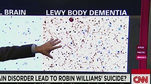 What is Lewy body dementia?