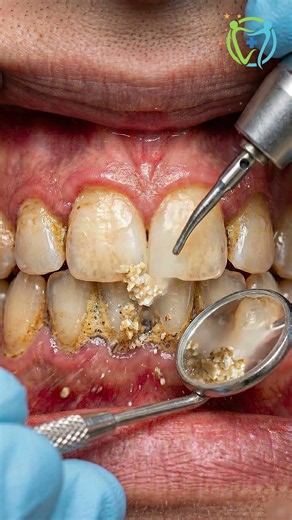 Plaque and Tartar Removed – Hard buildup cleaning from teeth